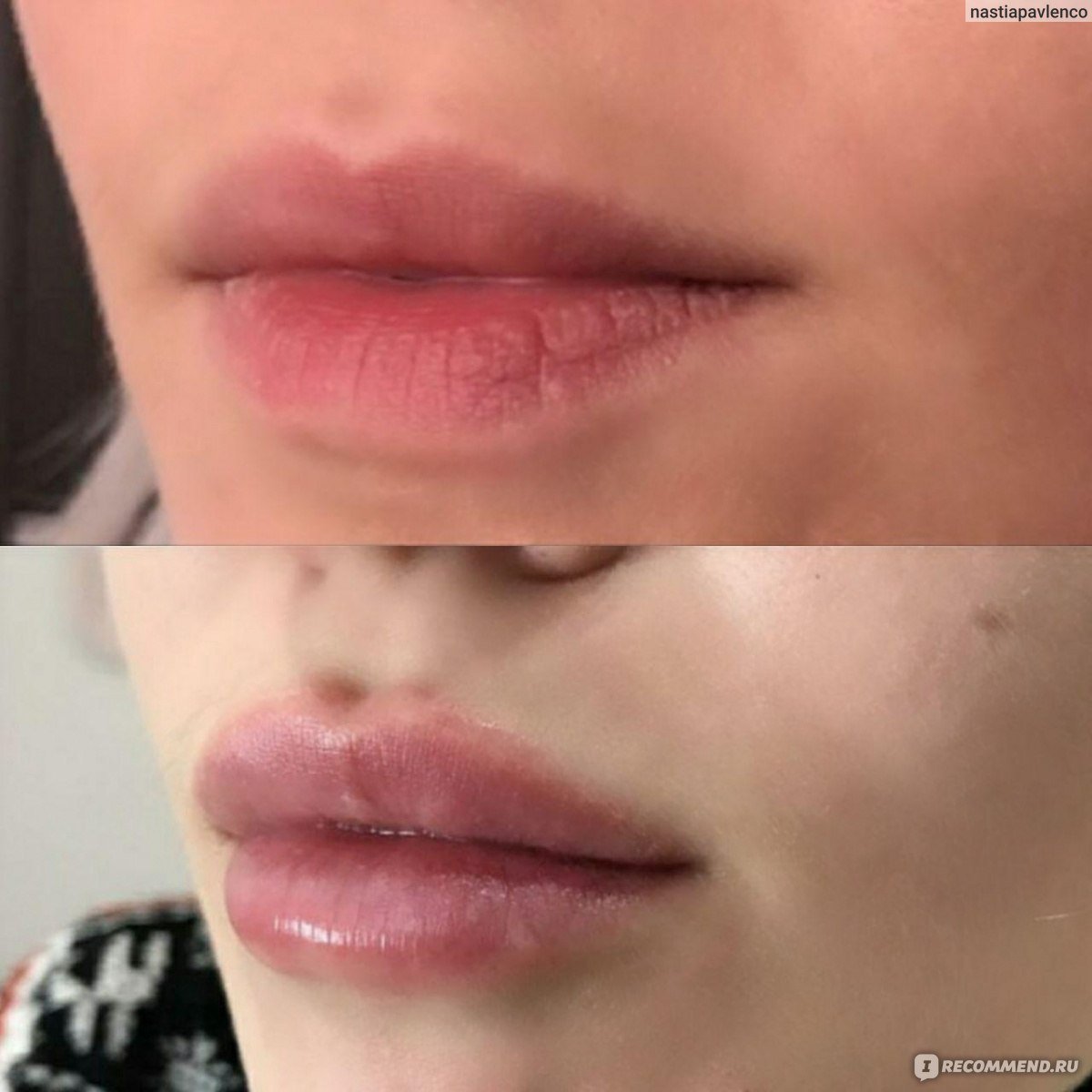 Контурная пластика губ Juvederm Ultra 3