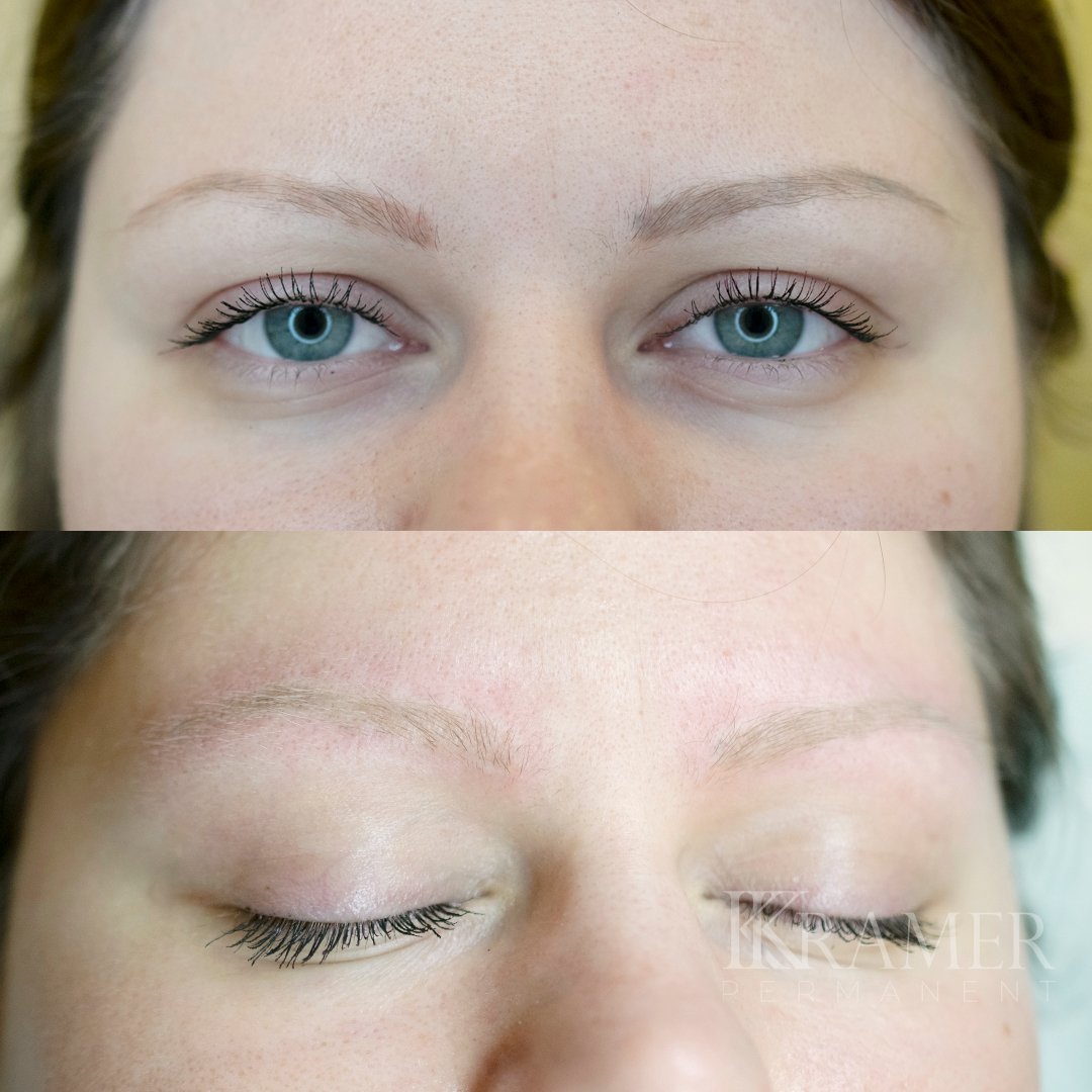 Лазерное удаление перманентного макияжа бровей фото до и после