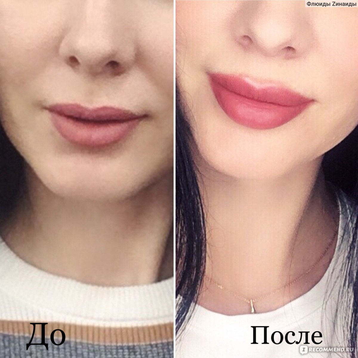 Увеличение губ до и после