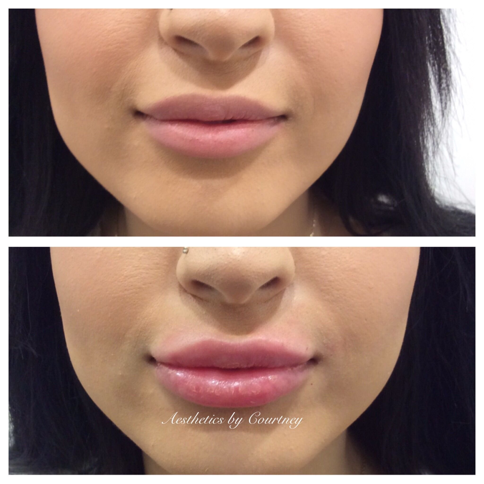 Приложение увеличивающее губы. Формы губ для увеличения гиалуроновой. Губы с ботоксом до и после.