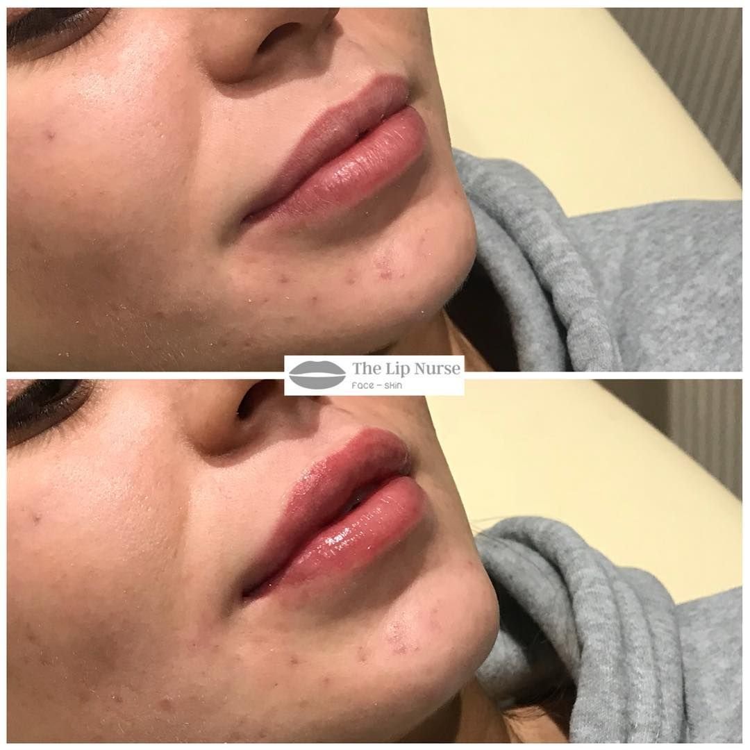 Tesoro филлер для губ отзывы. Juvederm 0.5 мл. Ювидерм Волифт 0,5. Ювидерм 3 0.5 мл.