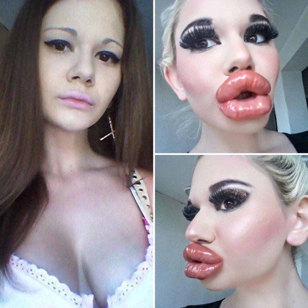 Тина Канделаки до ринопластики