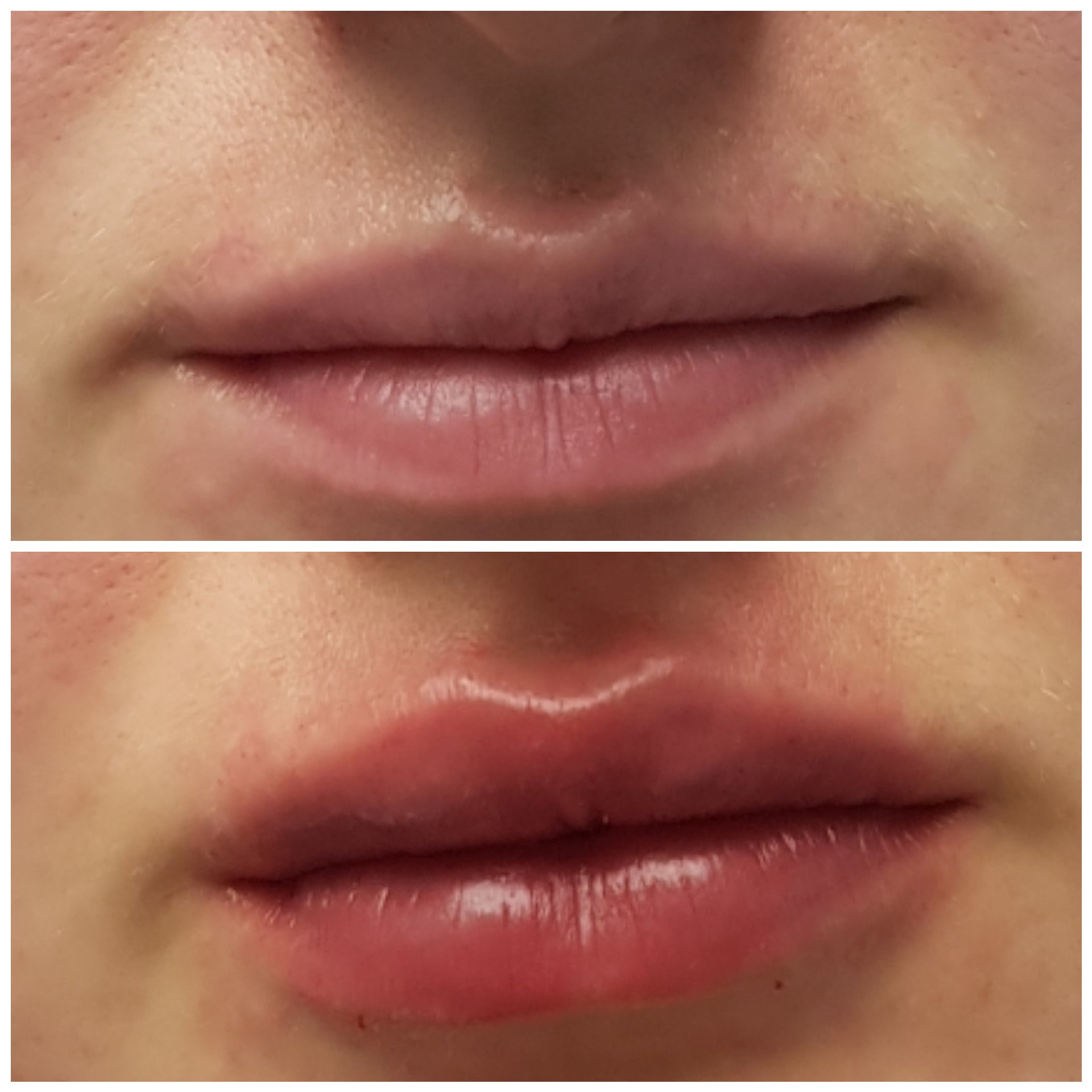 Увлажнение губ до и после. Контур губ гиалуроновой кислотой. Увлажнение губ гиалуроновой кислотой. Губы после контурной пластики. Контурная пластика губ до и после.