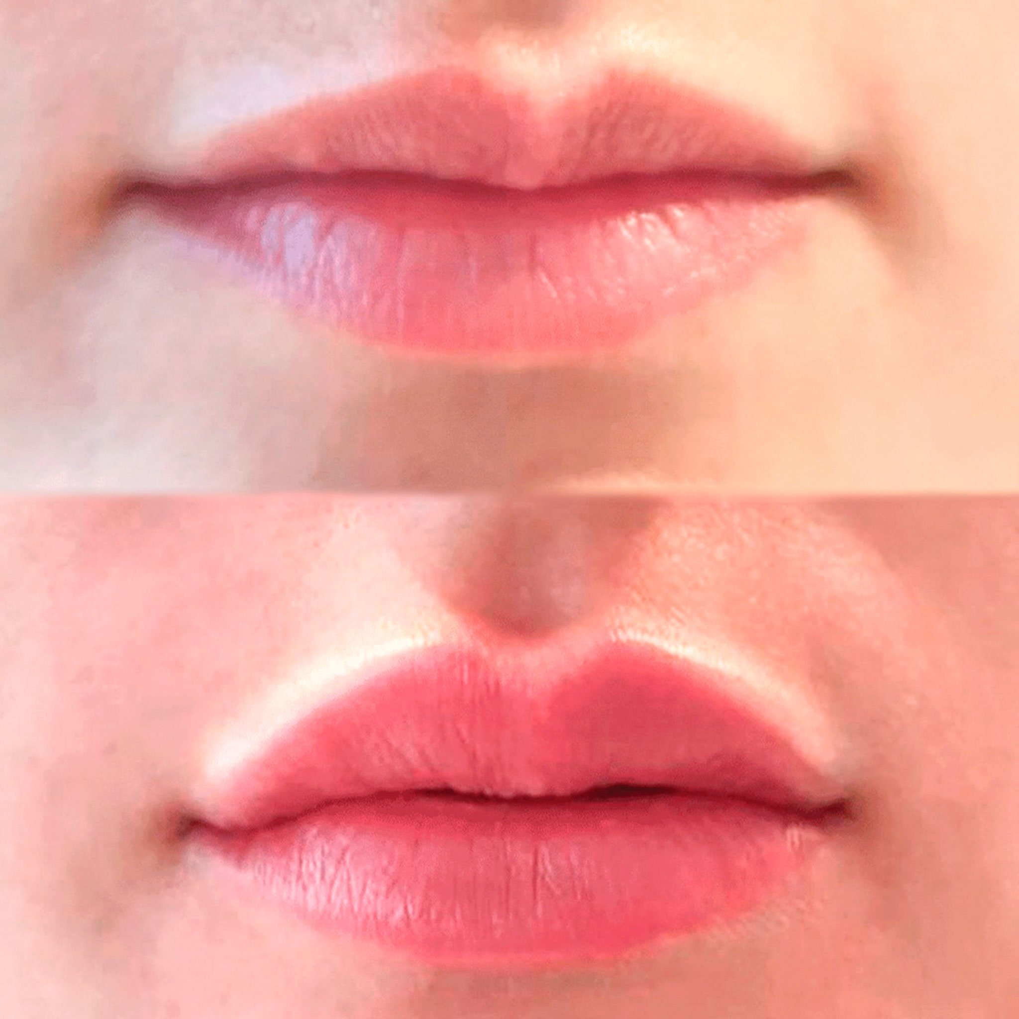 Увлажнение губ до и после. Контур губ гиалуроновой кислотой 1 мл. Увлажнение губ гиалуроновой кислотой. Контуринг губ гиалуроновой кислотой.