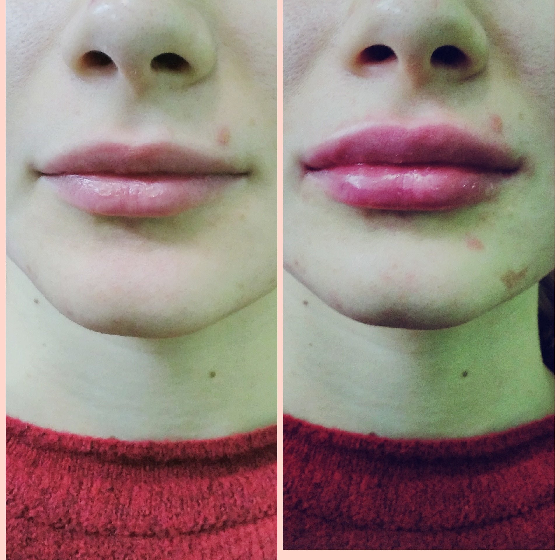 Контур губ гиалуроновой кислотой до и после фото