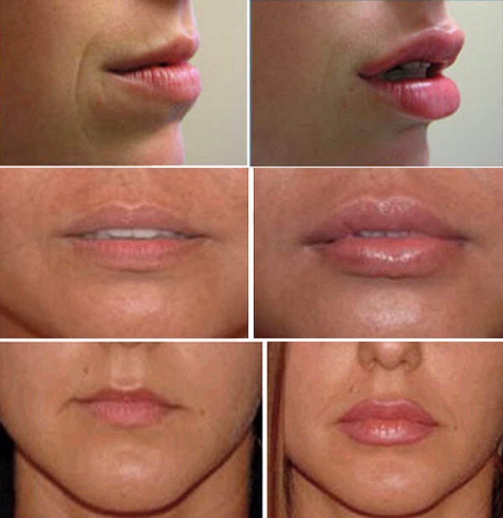 Увеличение губ до и после фото 1 мл тонкие губы