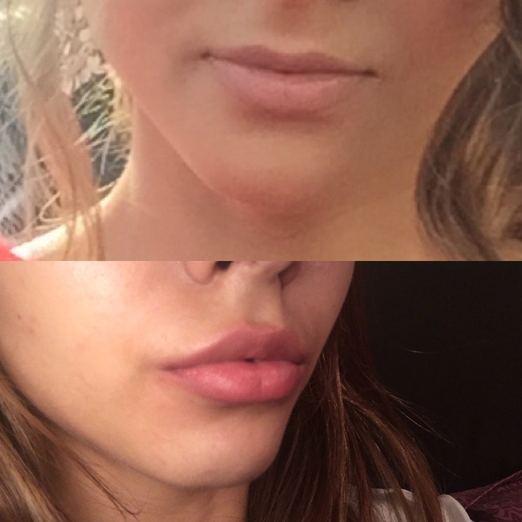 Подколотые губы фото до и после