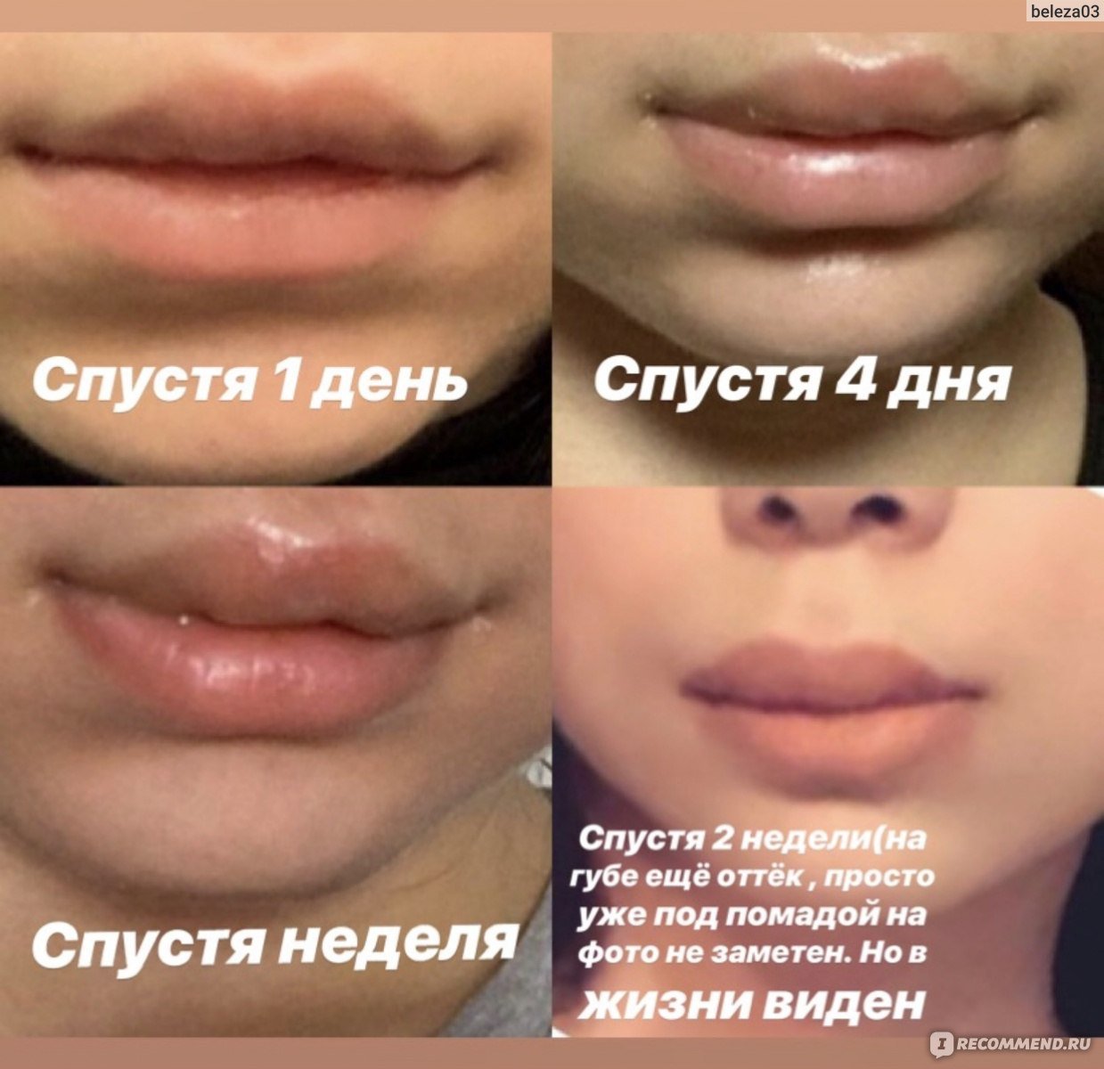 увеличение губ мужчинам фото