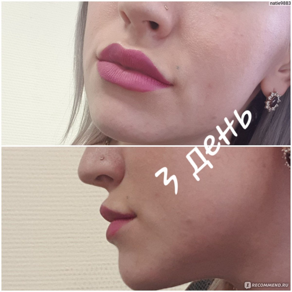 Реклама инъекций красоты