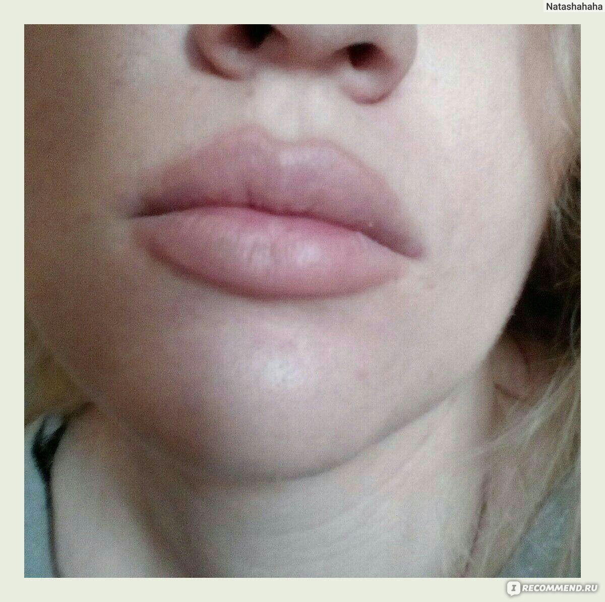 Фото губ после увеличения 1 мл филлера
