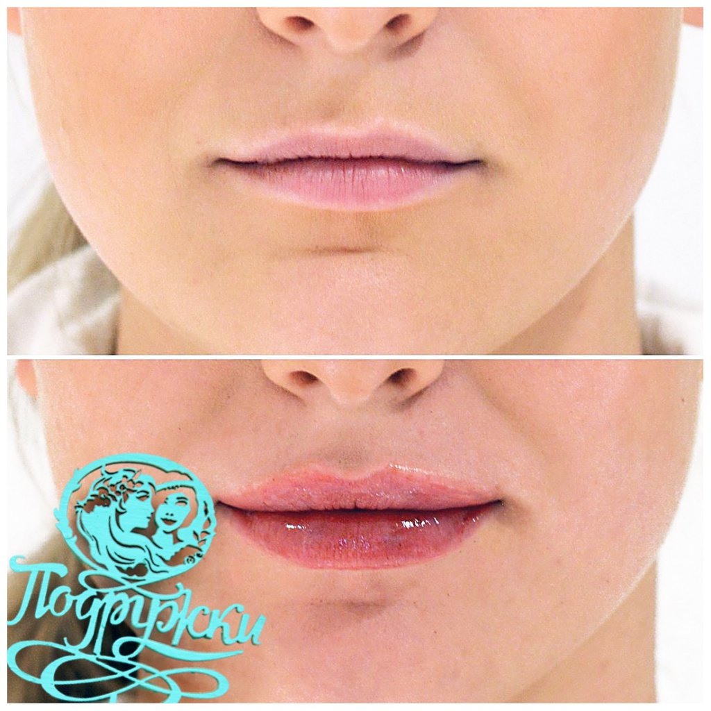 Lips files before after