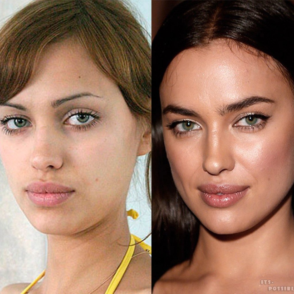 Ирина Шейк хейлопластика