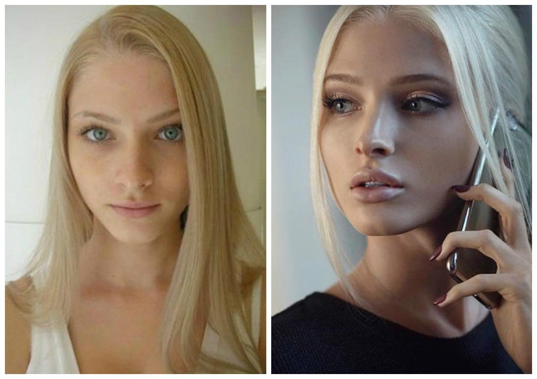 Алена Шишкова после пластики