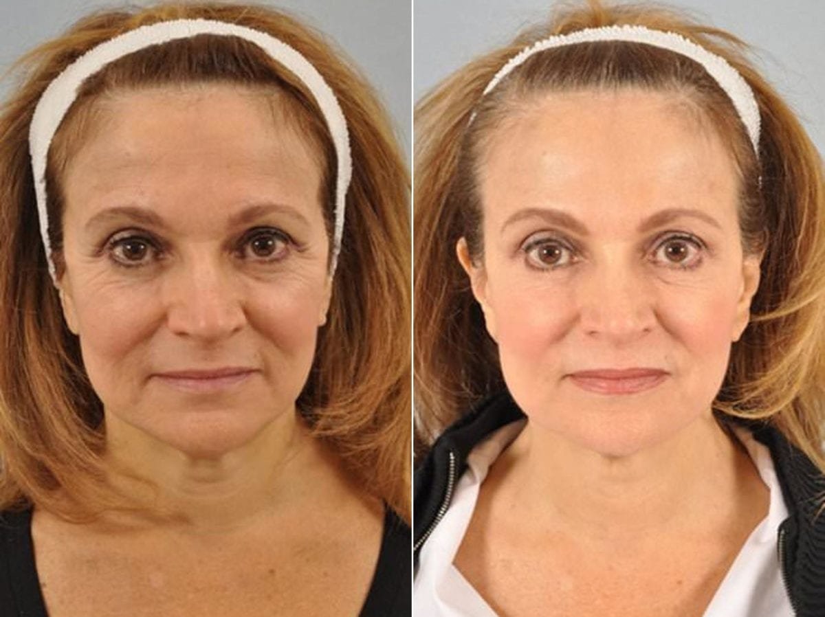 Botox before and after