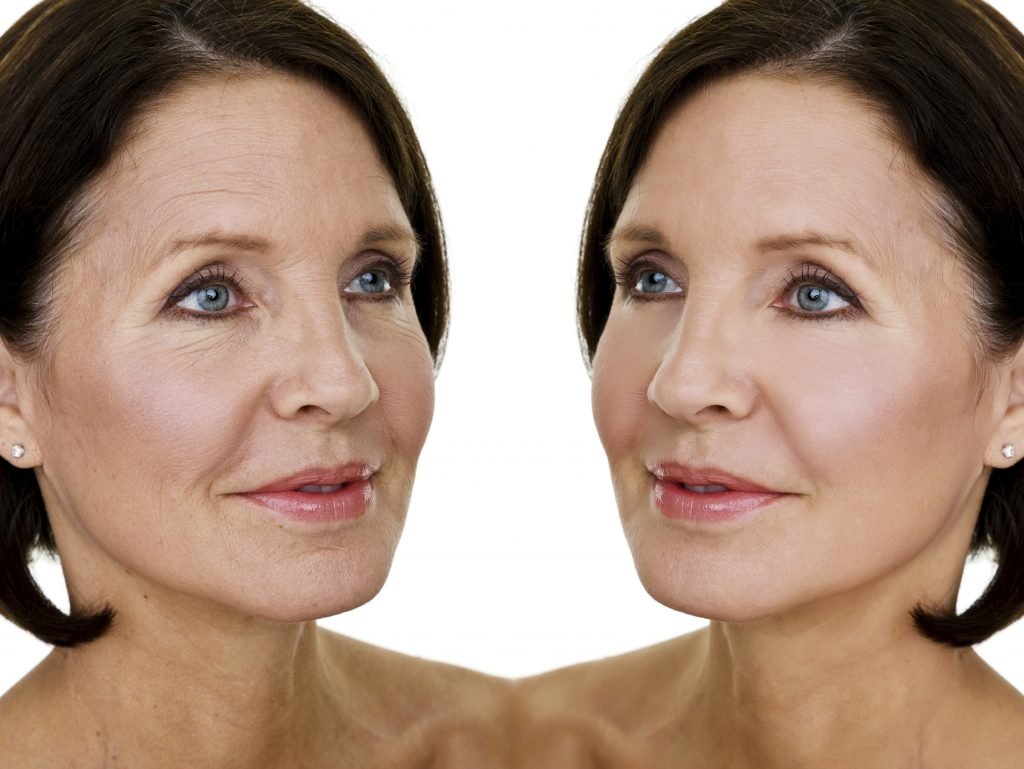 Botox before and after