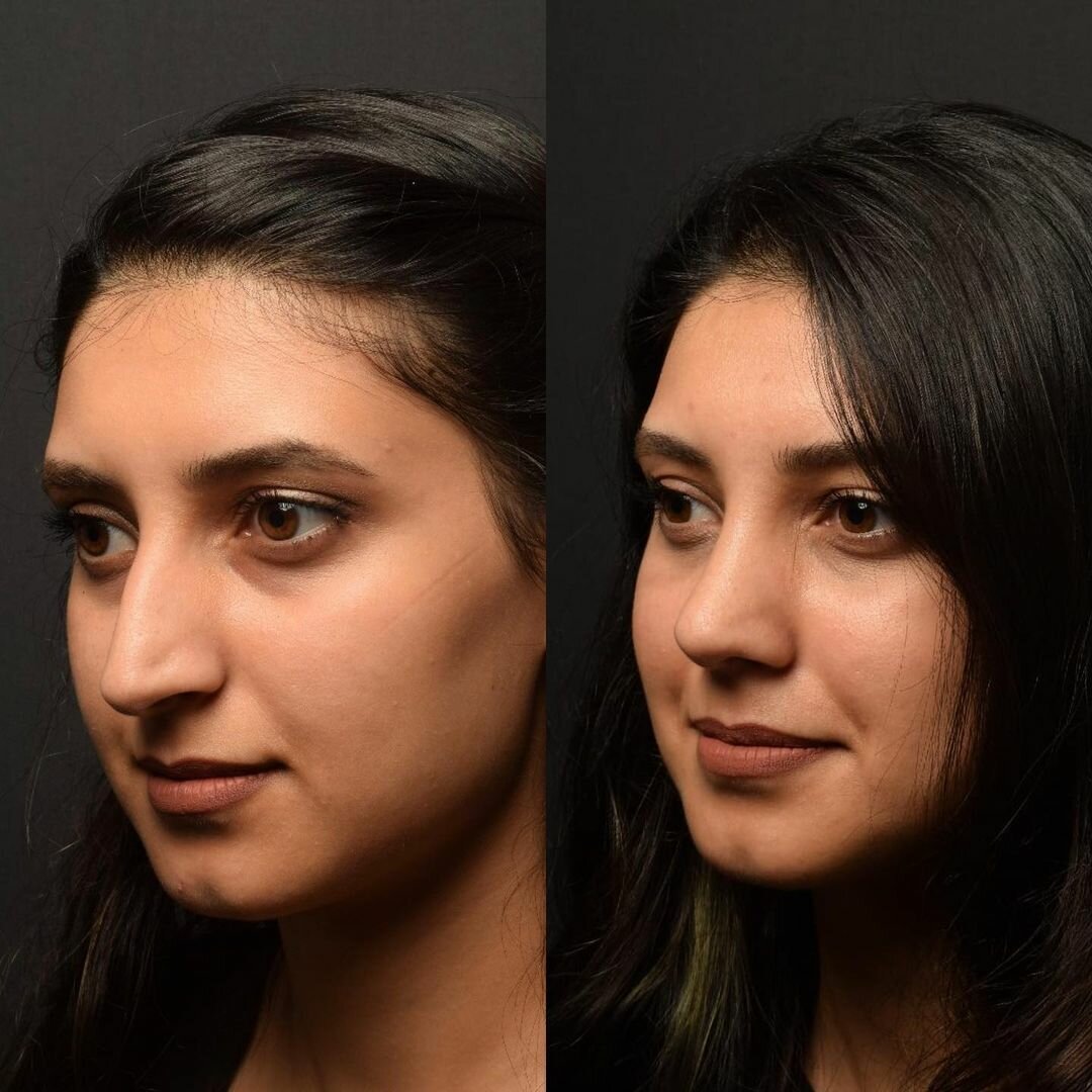 Фото ринопластики до и после нос. Гадагатль Анзаур Айдамирович ринопластика.
