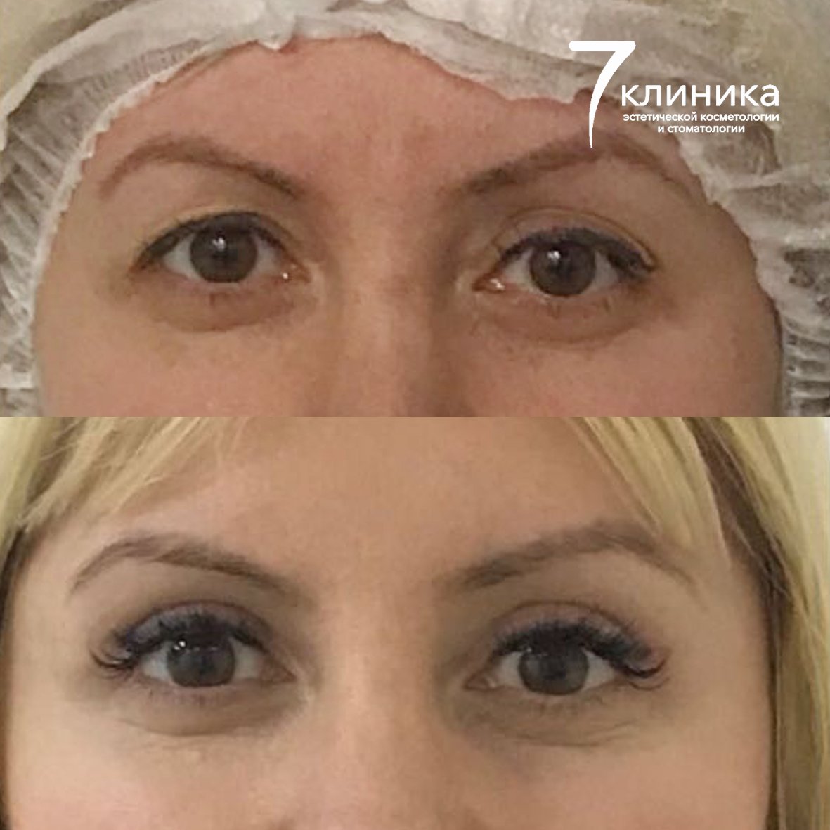 .Блефаро блефаропластика верхних верхних