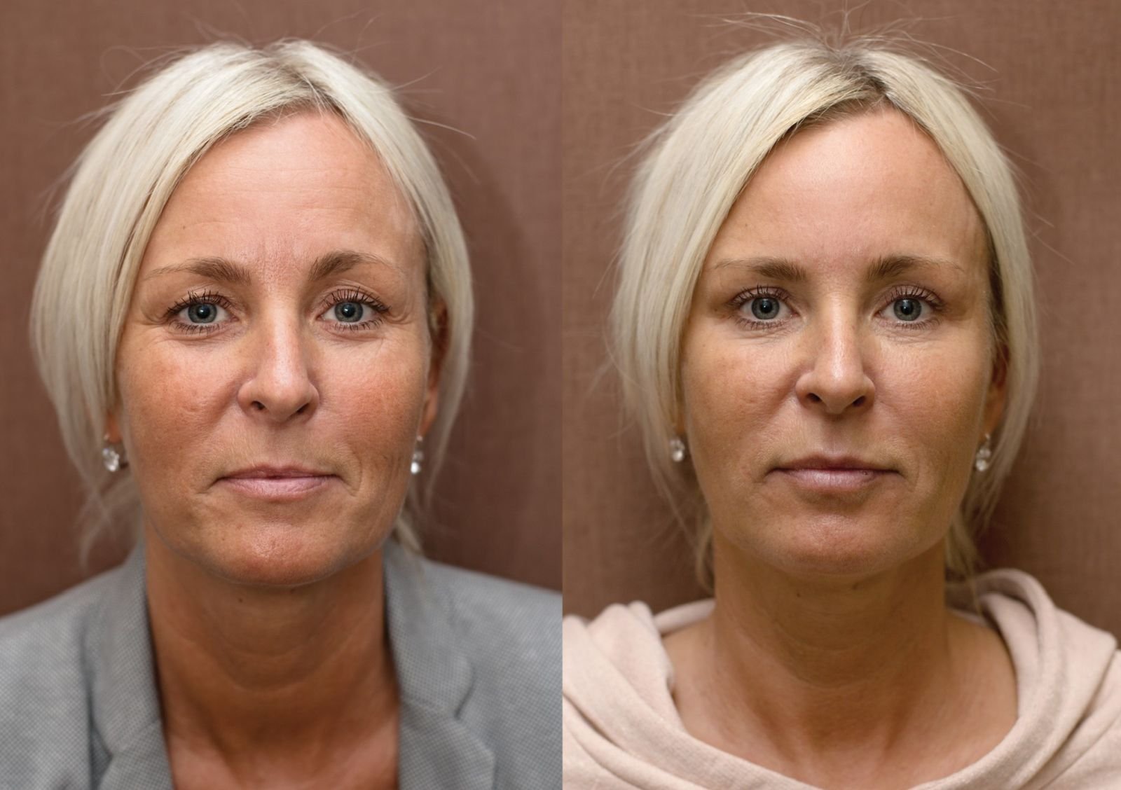 Филлер человек. Плазмотерапия плазмолифтинг косметология. Плазмолифтинг лица до и после.