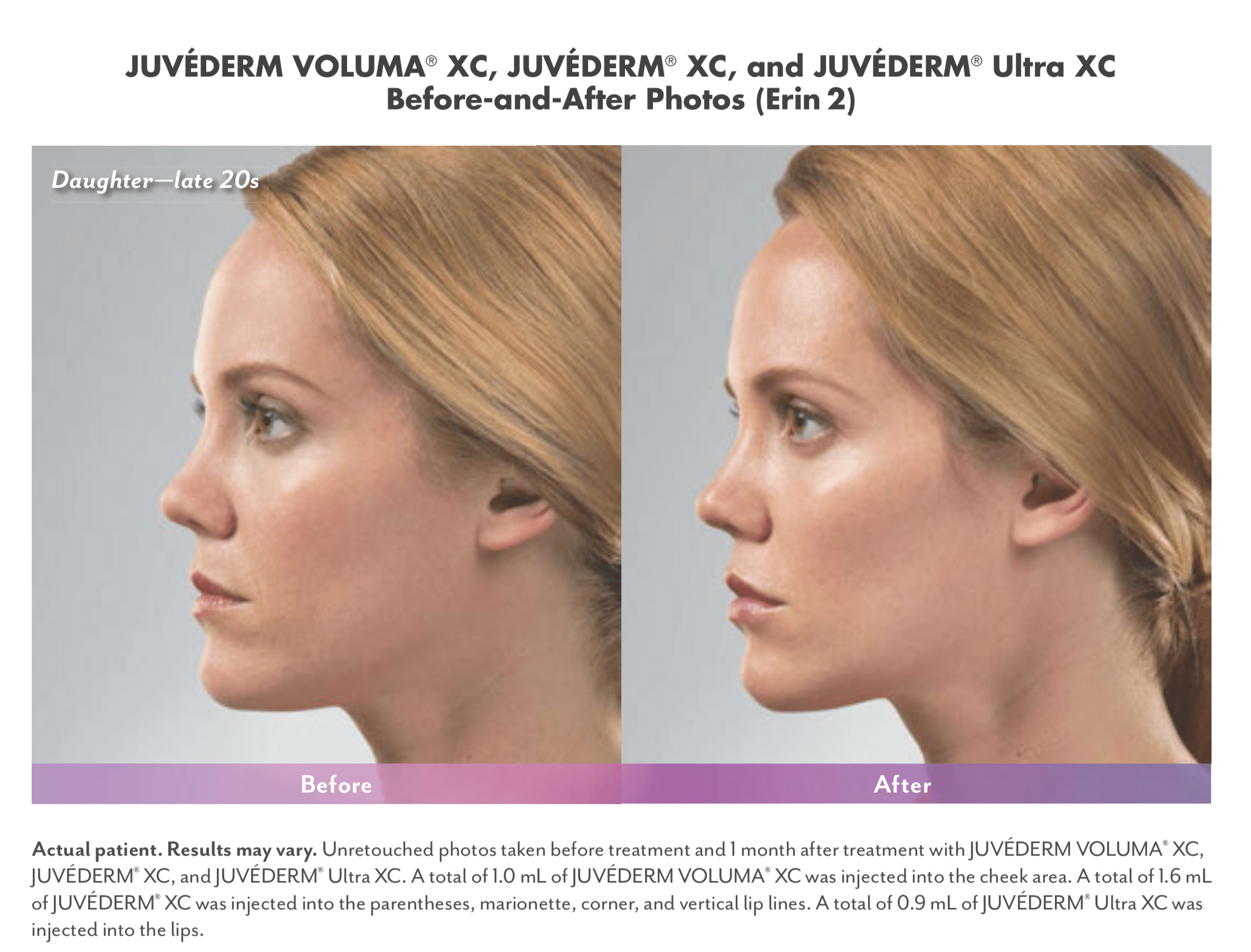 Подбородок филлерами фото до и после. Ювидерм Волюма. Juvederm Voluma подбородок.