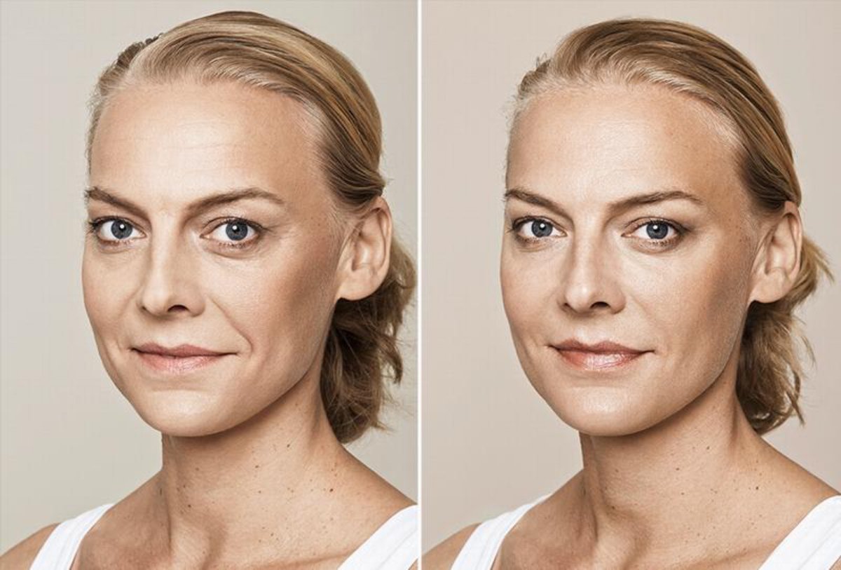 Restylane Skinboosters Vital Light