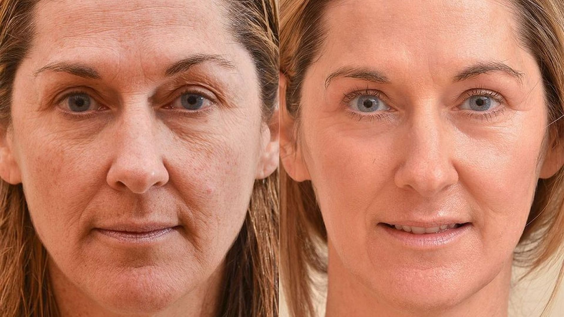 Wrinkling face. Омоложение лица до и после. Морщины до после. Лицо до после. Поазмо лифтинг до и после.