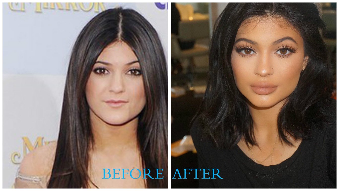 Kylie Jenner before Plastic Surgery