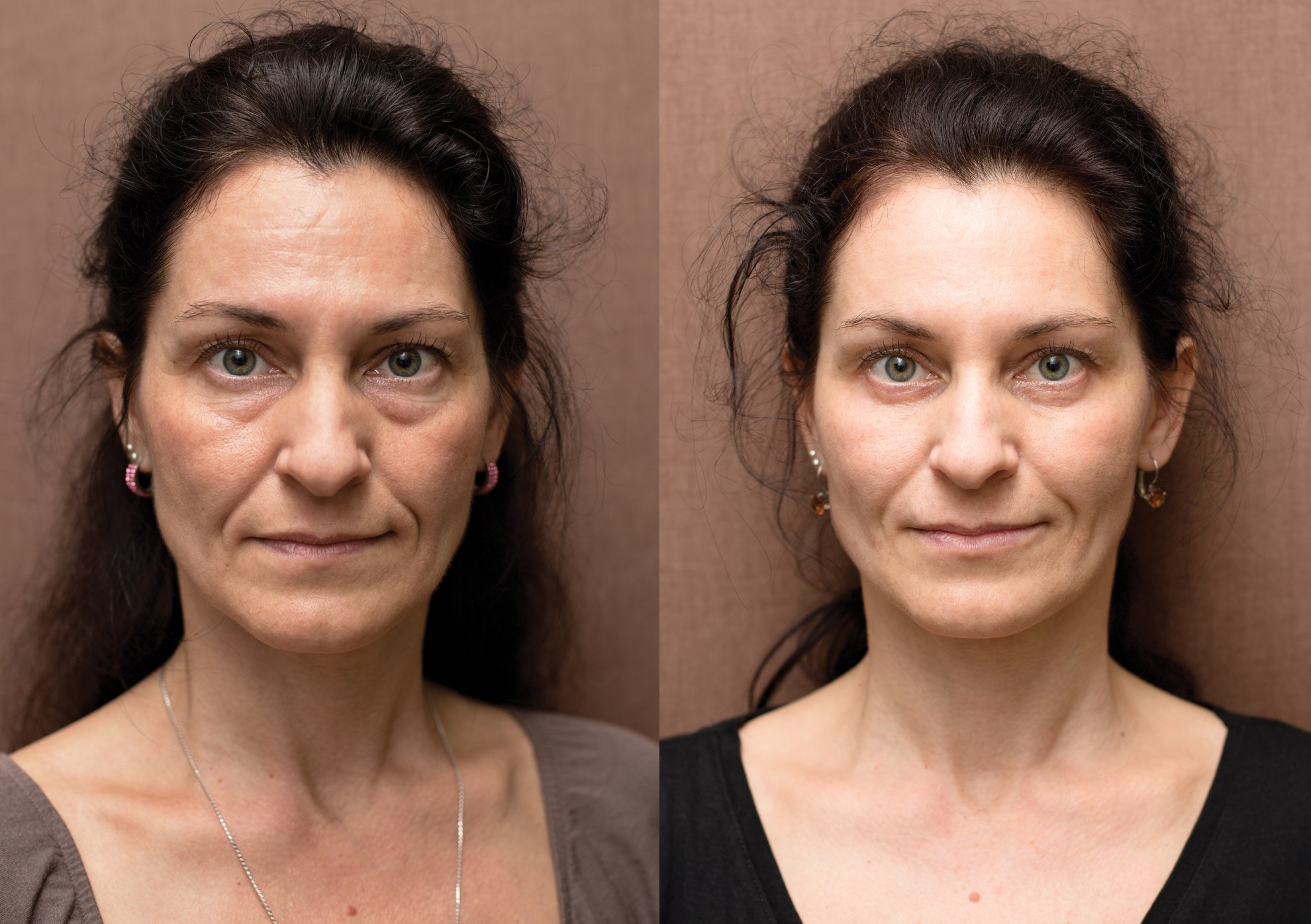 Процедура для лица после 60. Ботокс для лица до и после. Морщины до после. Уколы красоты до и после. Девушка с морщинами.