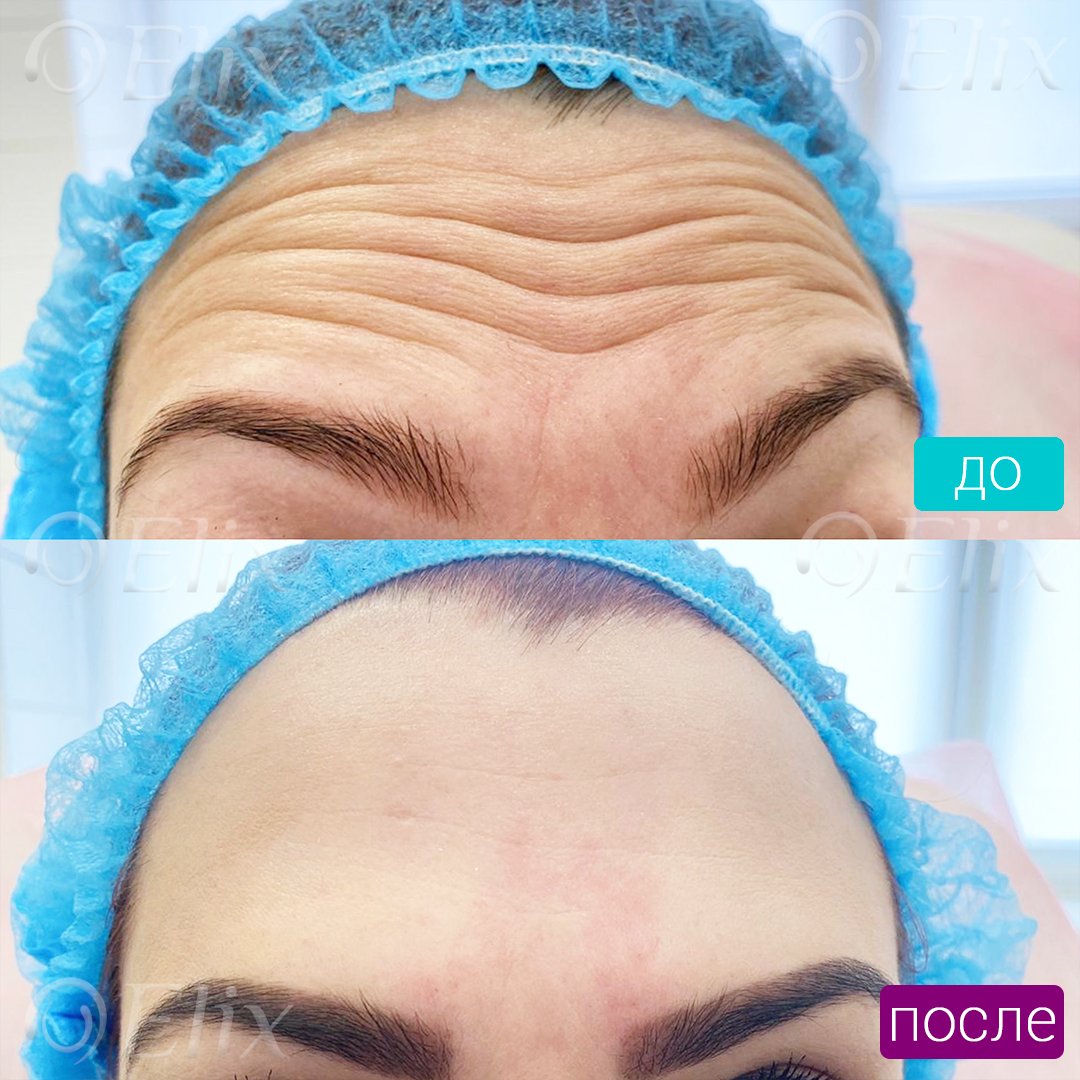 Лицо до и после ботокса