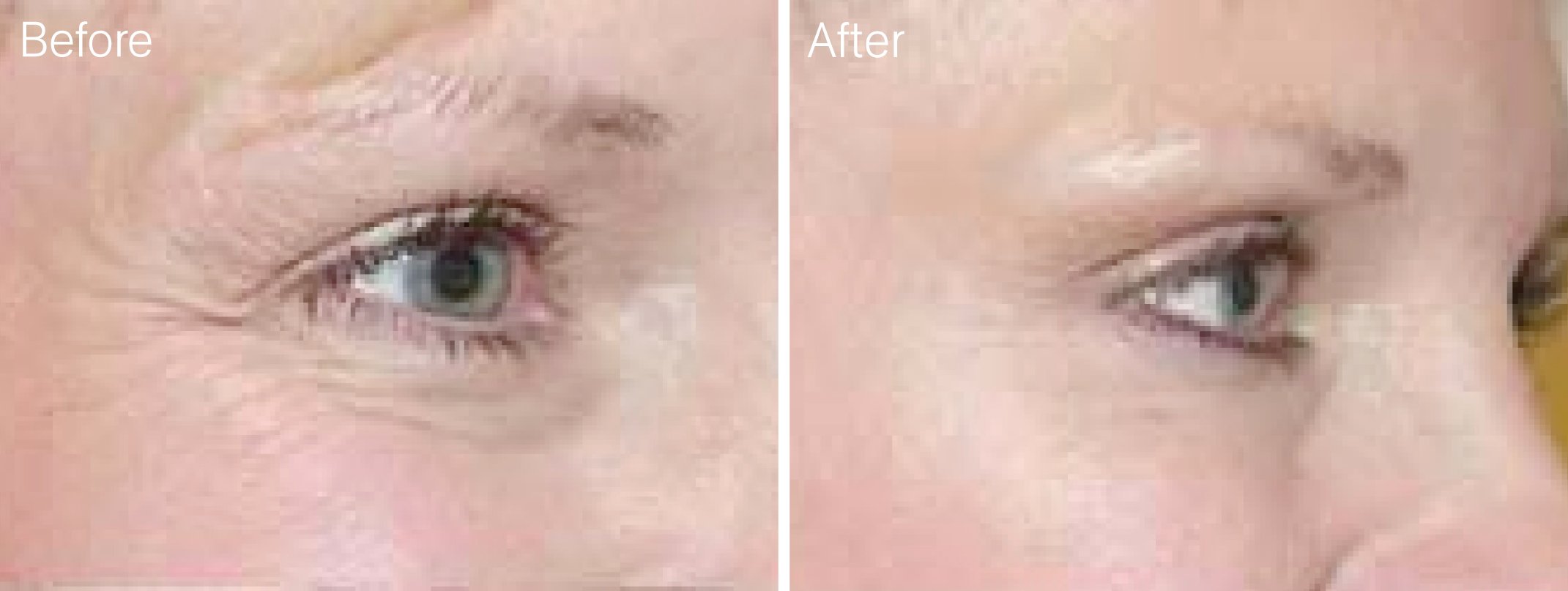Прошить морщины. Мезотерапия вокруг глаз. Ботокс под глаза до и после. Ботокс вокруг глаз.
