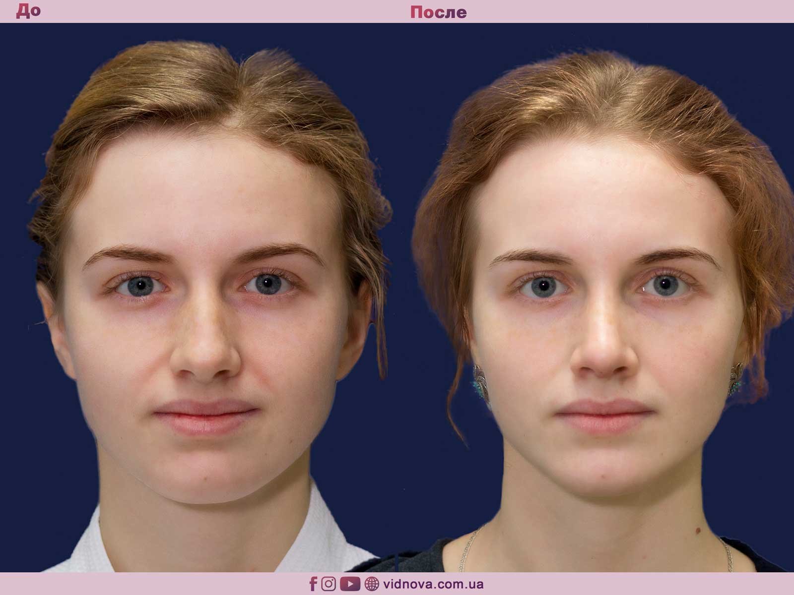 Фото ринопластики до и после нос. Пластика носа. Уранопластика до и после. Пластика кончика носа. Нос до и после ринопластики.