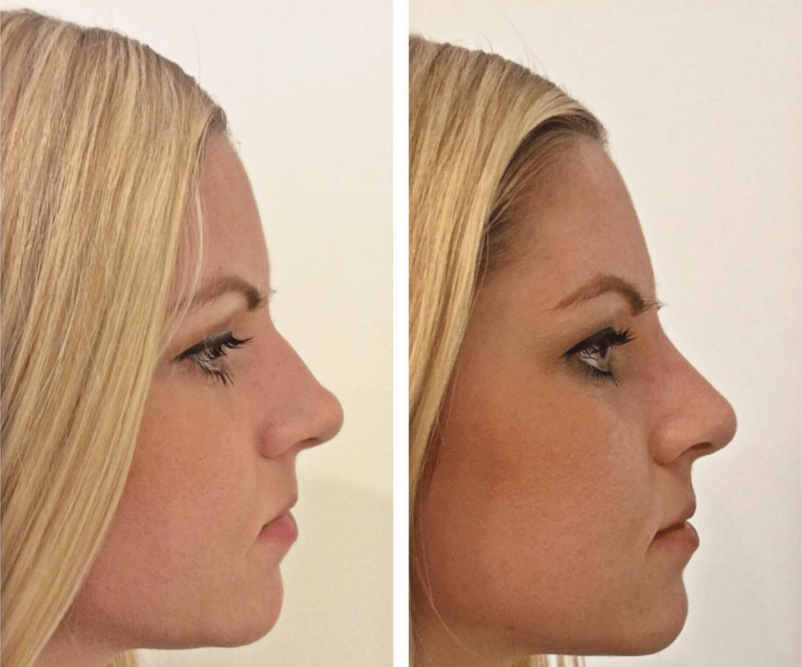Коррекция носа филлерами до и после