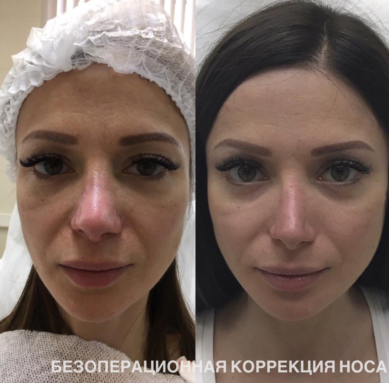 Пластика ноздрей