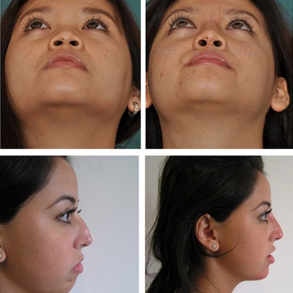 Увеличение носа филлерами фото до и после