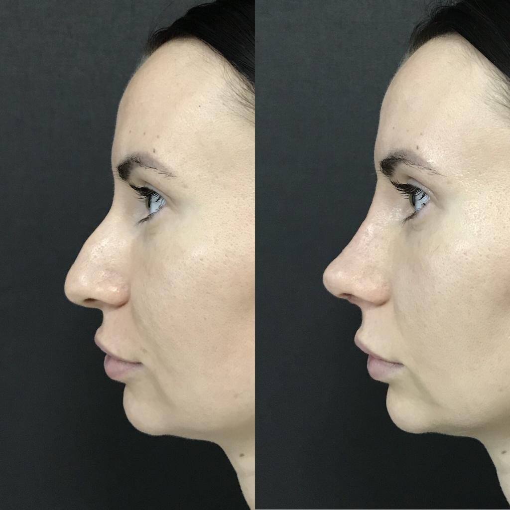 Ринопластика носа без операции фото