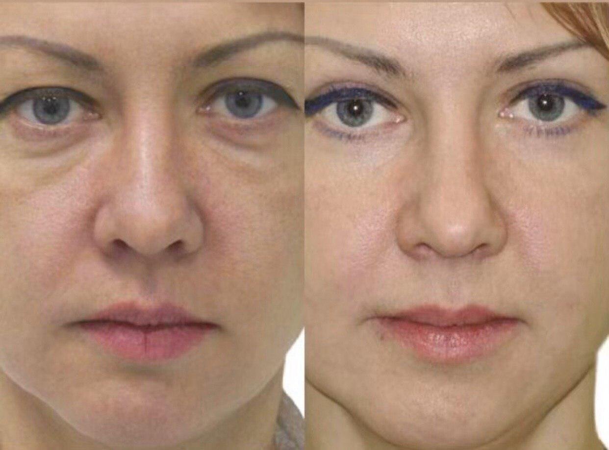 верхняя блефаропластика до и после фото женщины