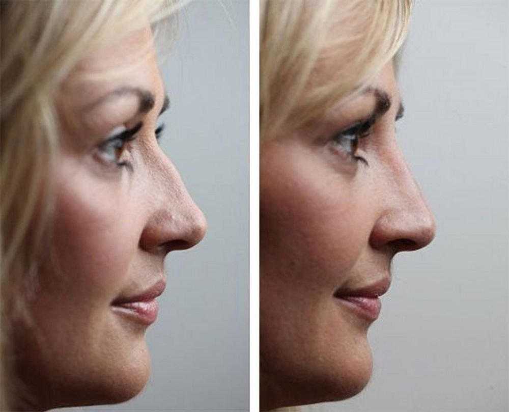 Исправить нос филлерами фото до и после