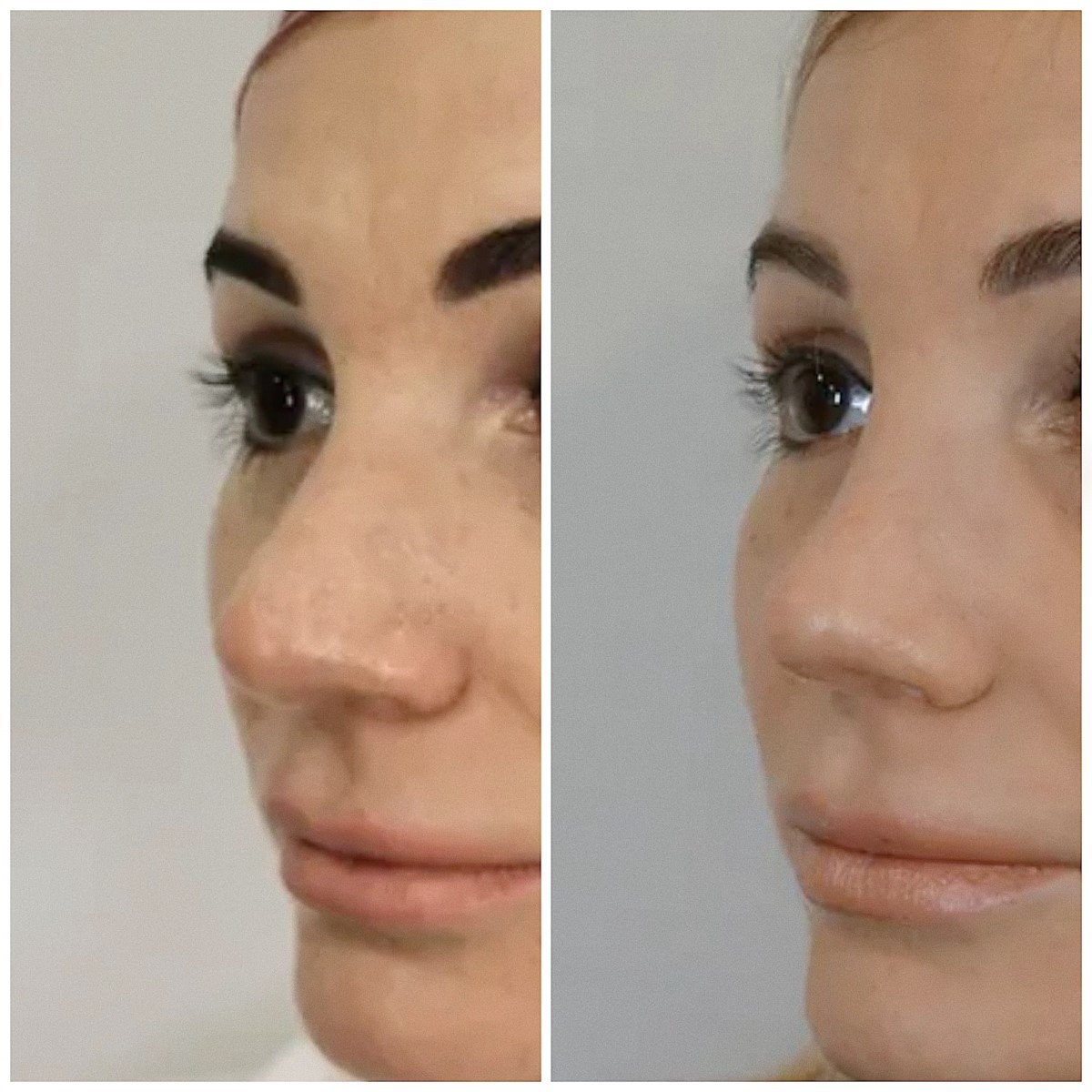 Уменьшить нос макияжем до и после