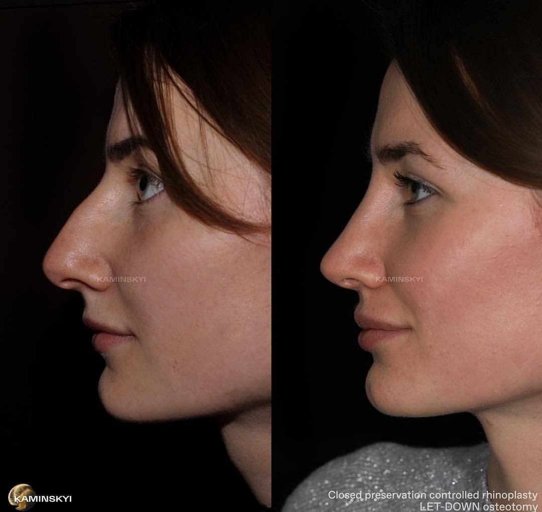 Нос после ринопластики по месяцам фото