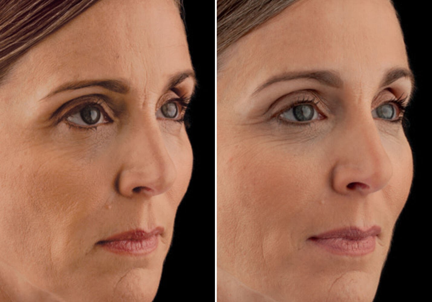 Филлер радиесс для лица эффект до и после фото