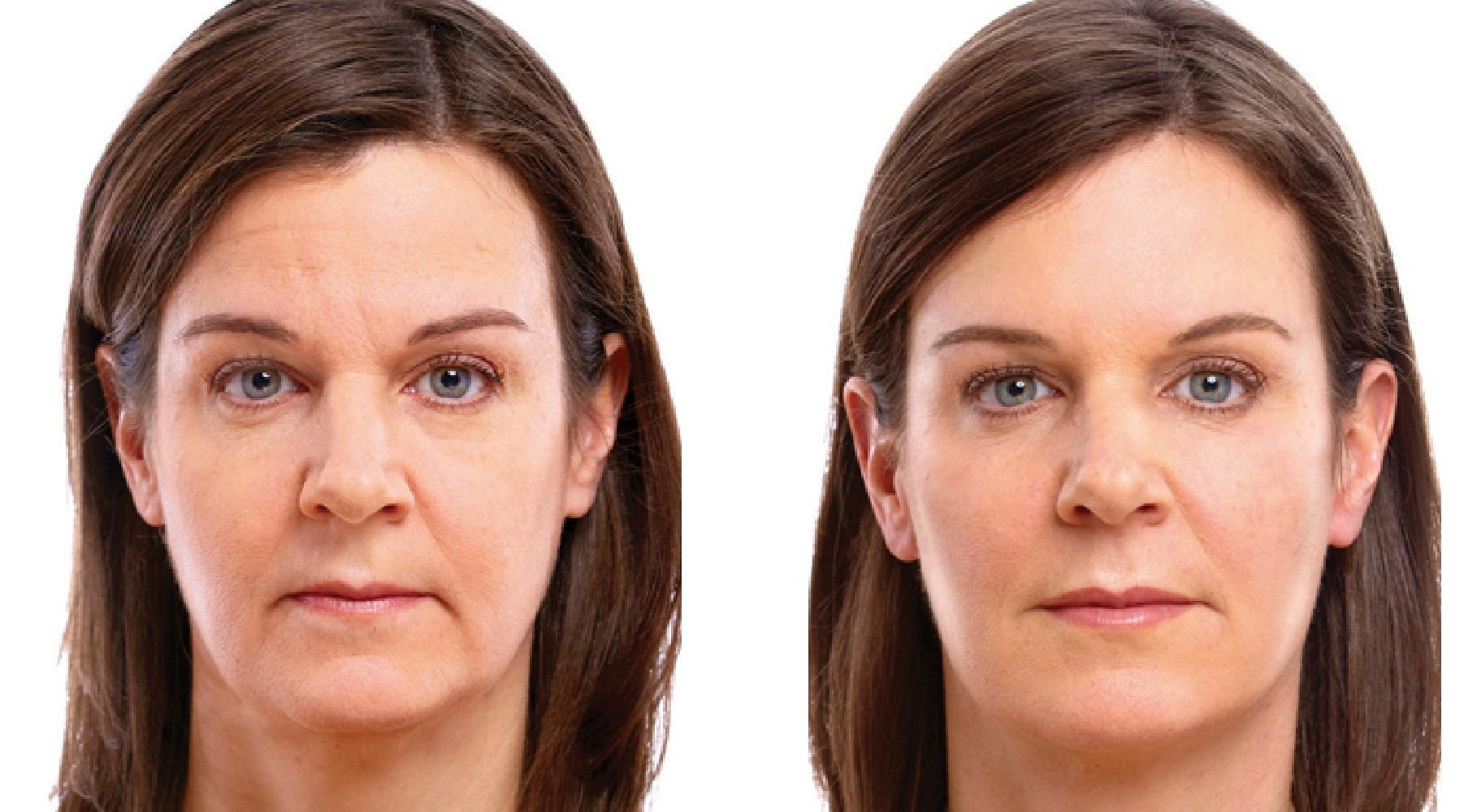 Морщины на лбу у женщин. Массаж лица до и после. Морщины до после. Морщины на лице.