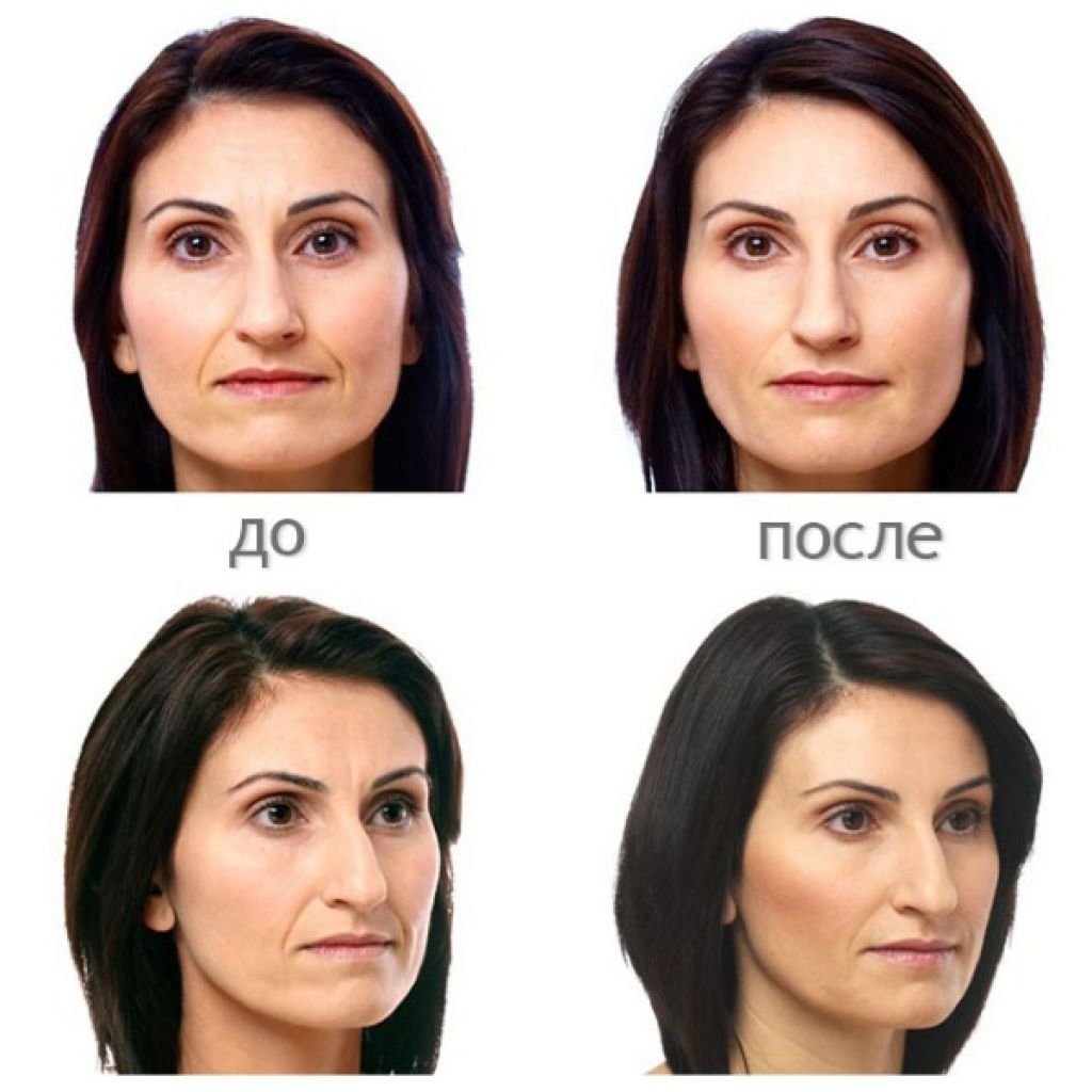 Коррекция овала лица до и после
