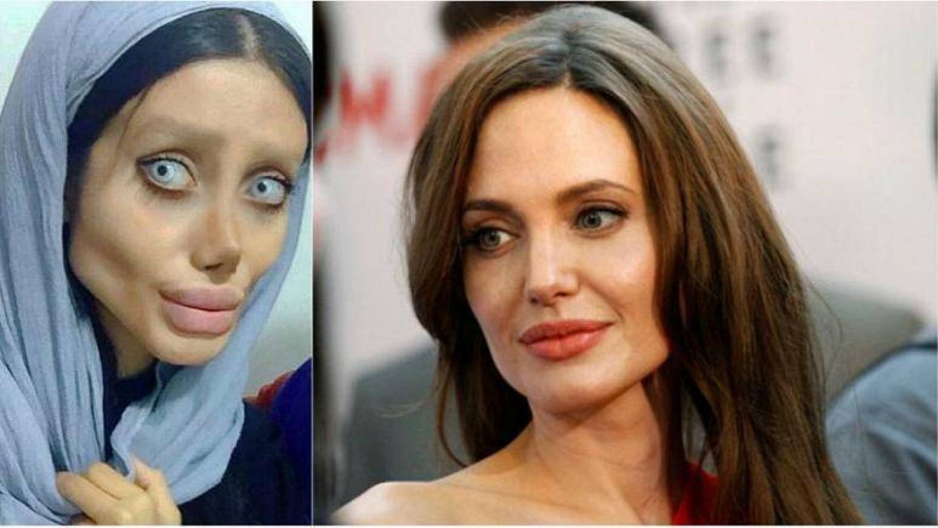 Уколы Джоли до и после