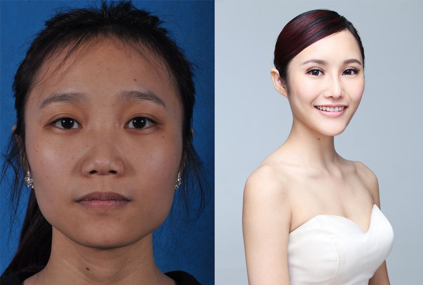 Можно ли увеличить глаза с помощью пластической операции фото до и после