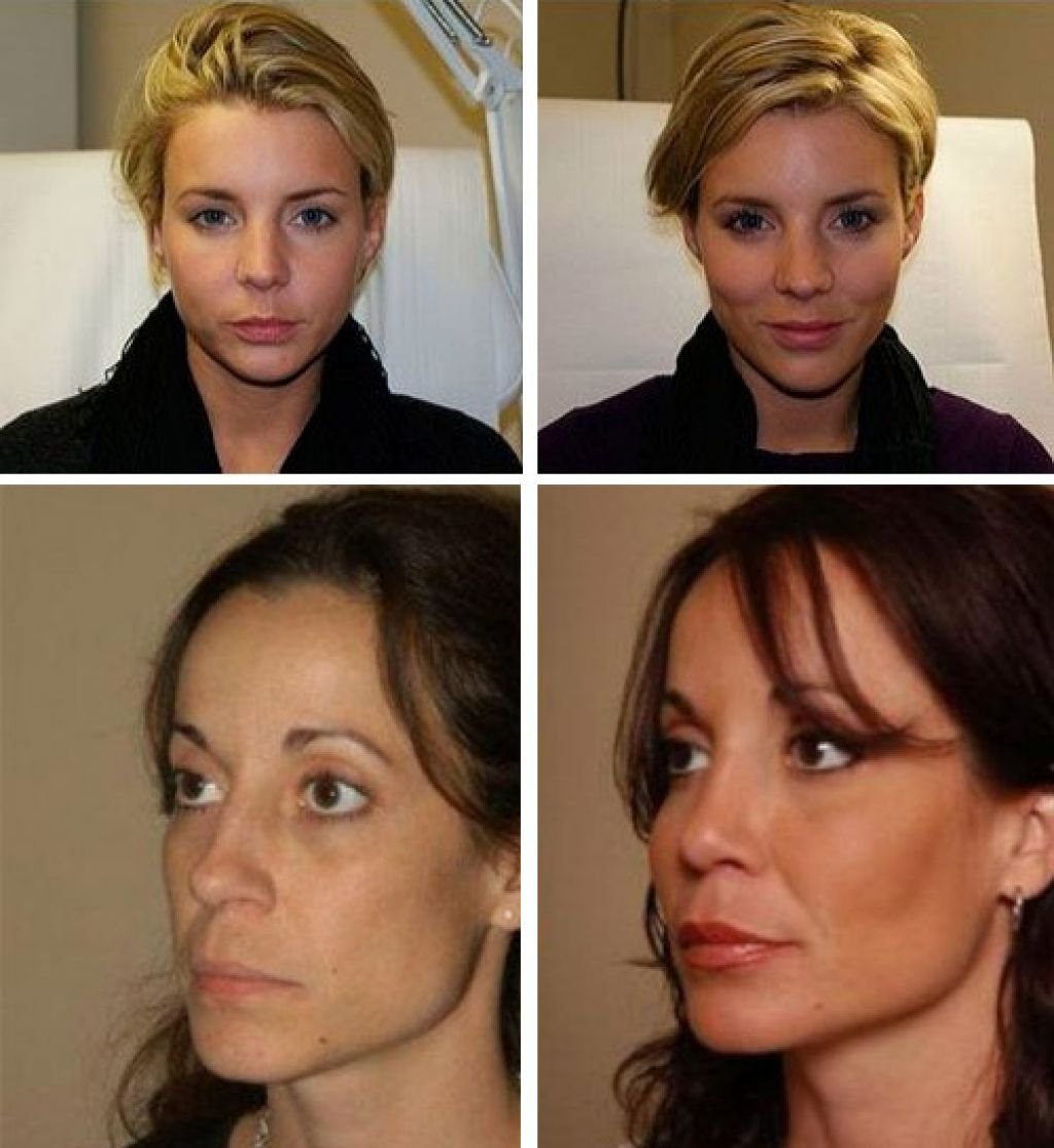Ботулинотерапия Full face