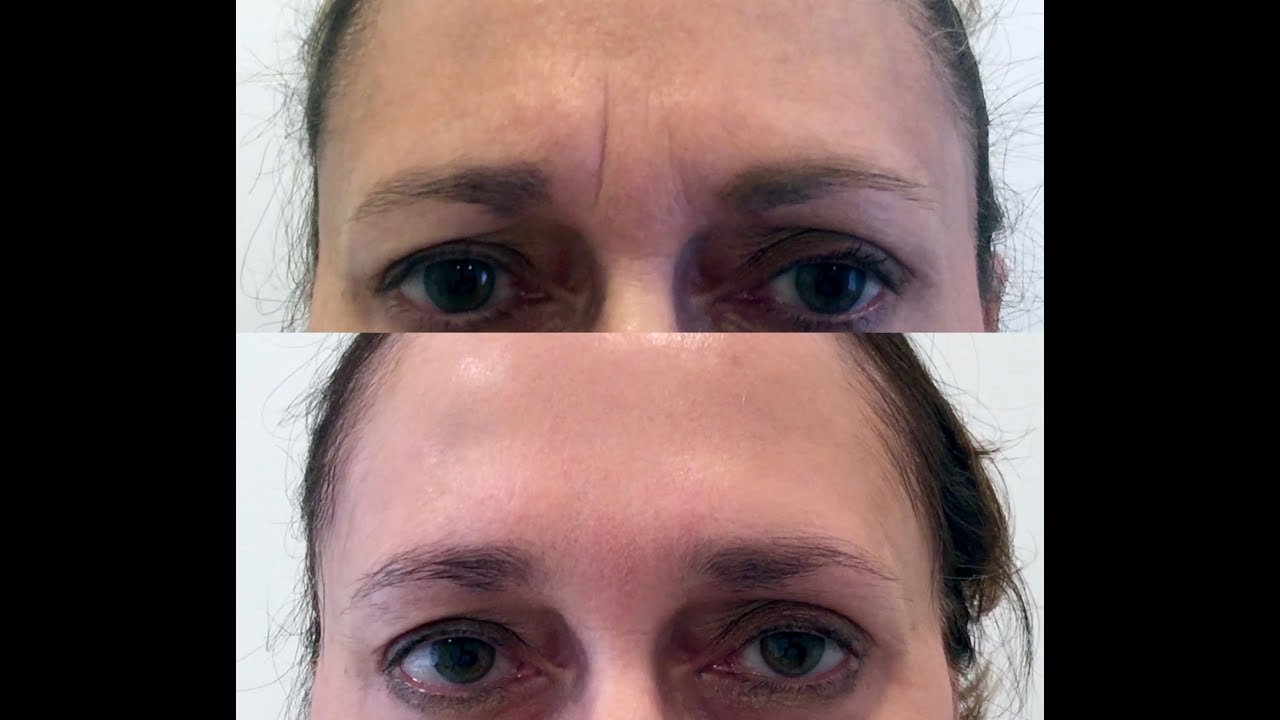 Ботокс в уголки глаз до и после фото