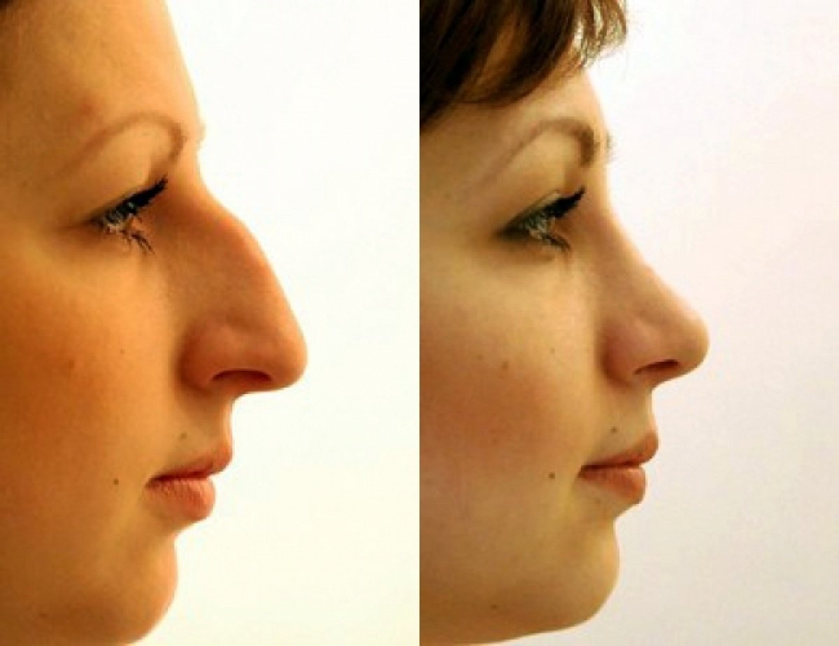 Ринопластика горбинки носа
