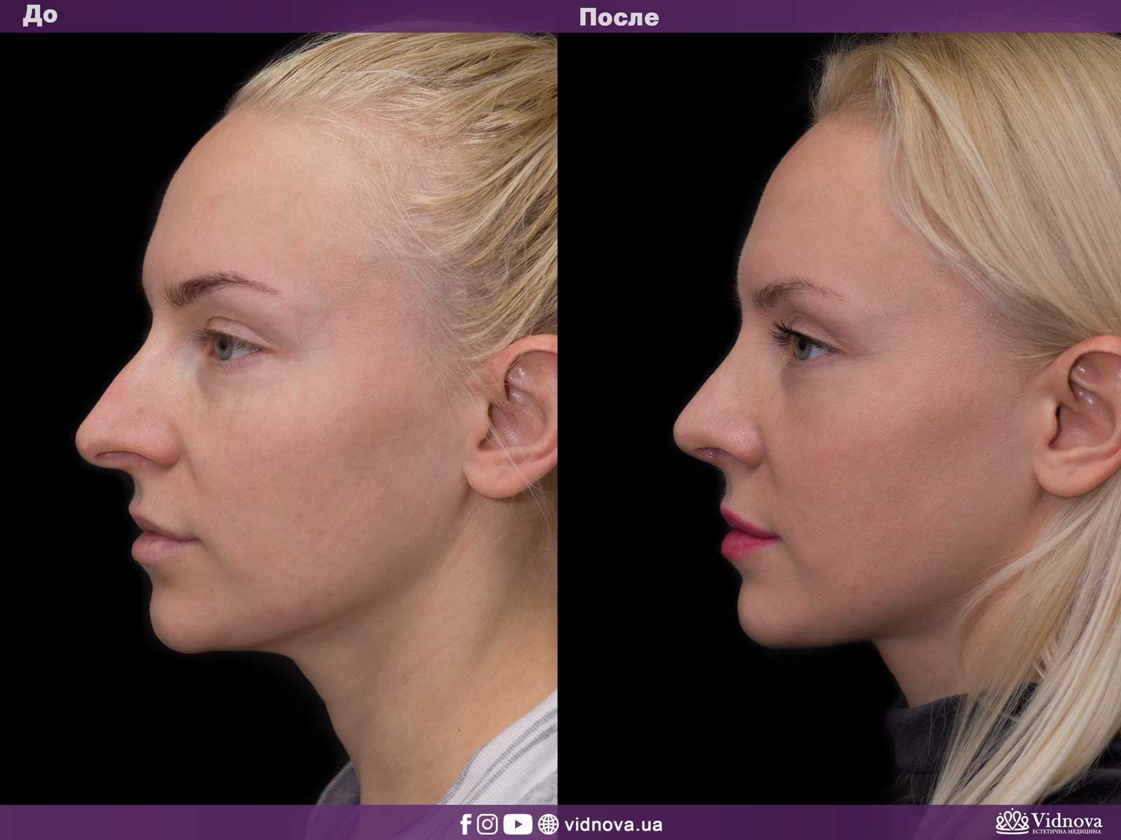 Фото ринопластики до и после нос. Гадагатль Анзаур Айдамирович ринопластика. Русецкий ринопластика.