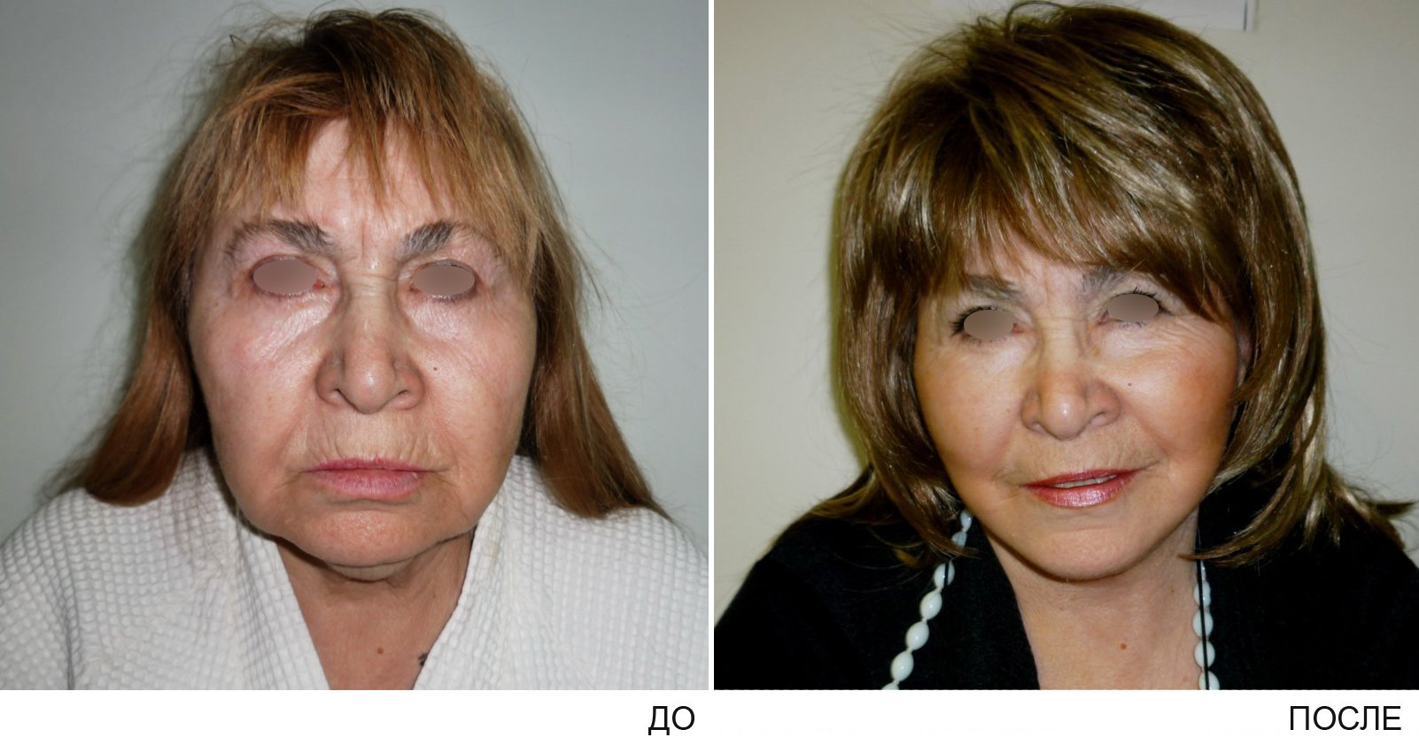 Операции после 70 лет. Пластика лица. Омолаживающие пластические операции. Пластические операции на лице до и после. Пластика лица до и после женщины.
