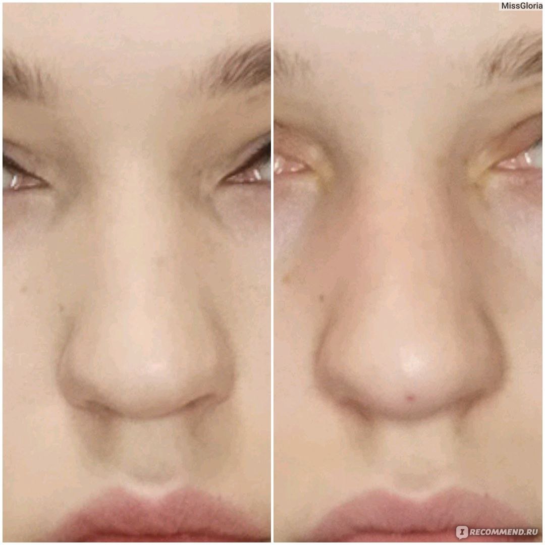 Сужение носа филлерами фото до и после