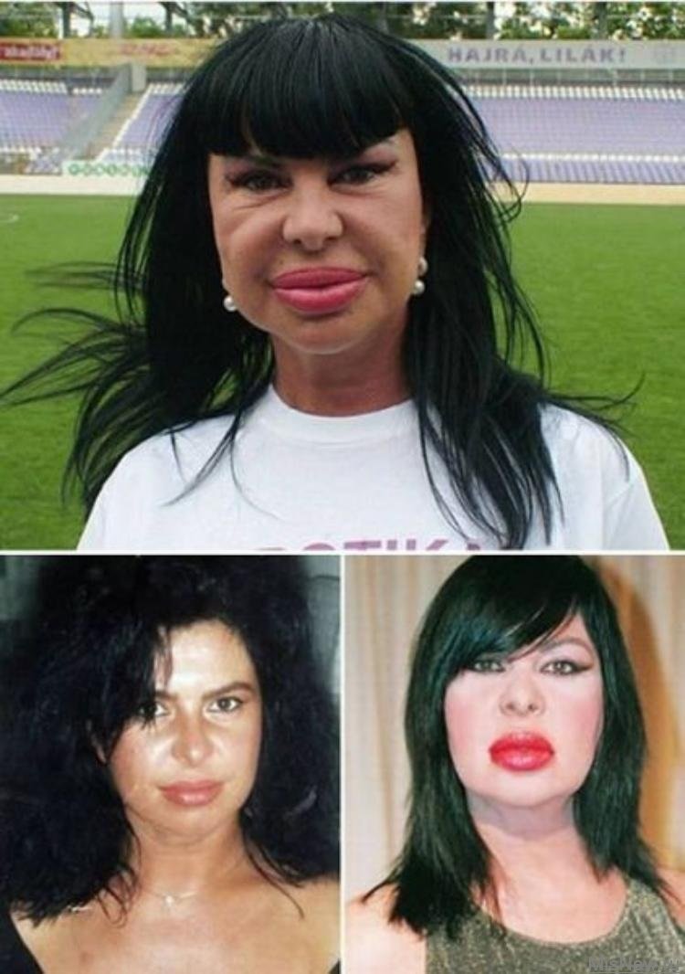 Девушки после пластики лица фото до и после